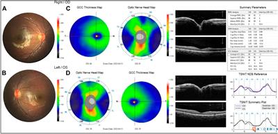 A boy with amblyopia and familial exudative vitreoretinopathy harboring a new mutation of LRP5 and OPA1: A case report